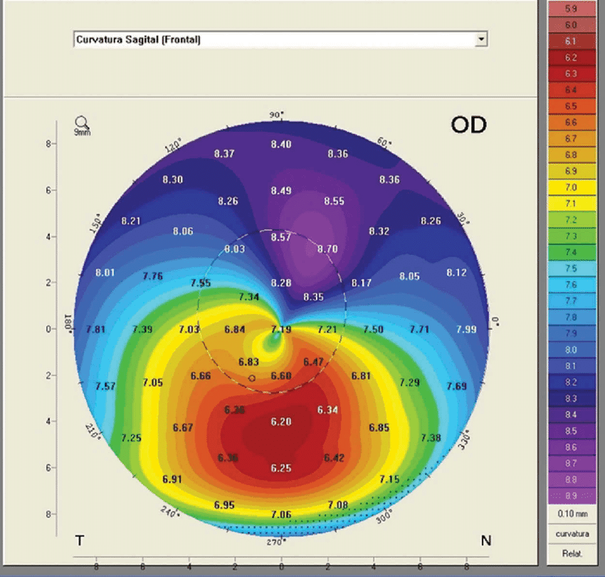Topographical map of an eye showing curvature data with various colors representing different curvature values.