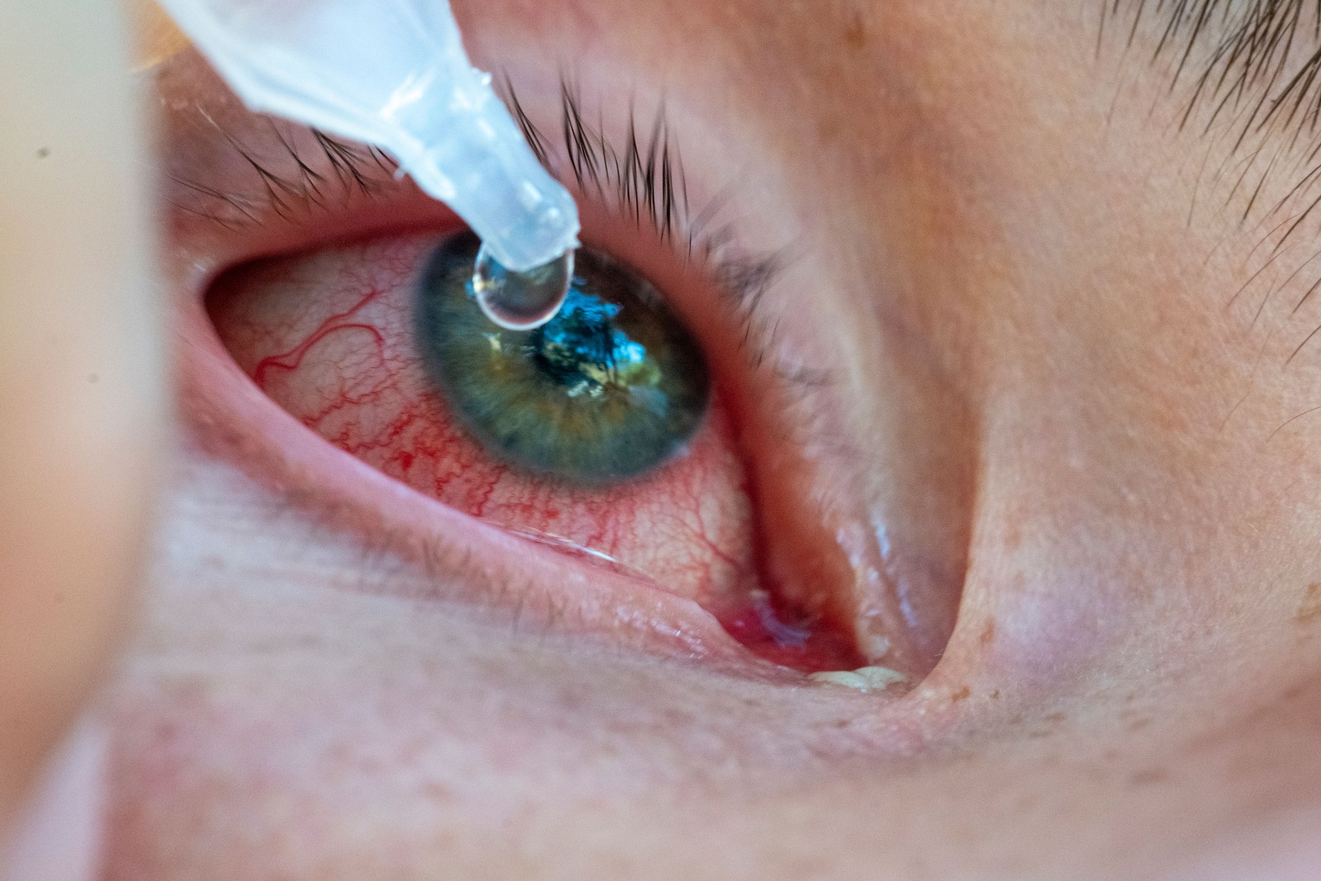 Eye drops are put on the red eyes of the green eyes man. stock photo